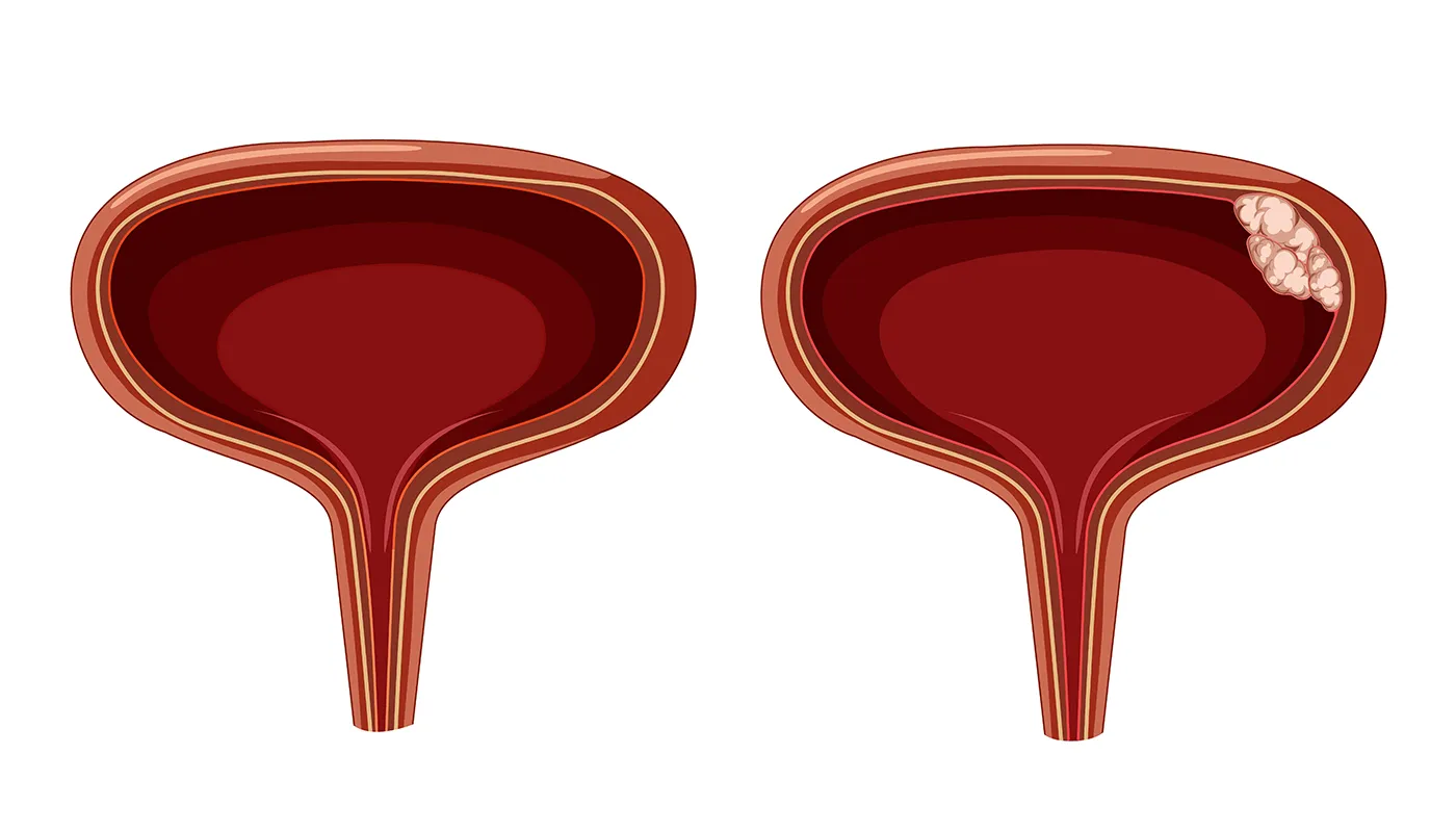 Bladder cancer