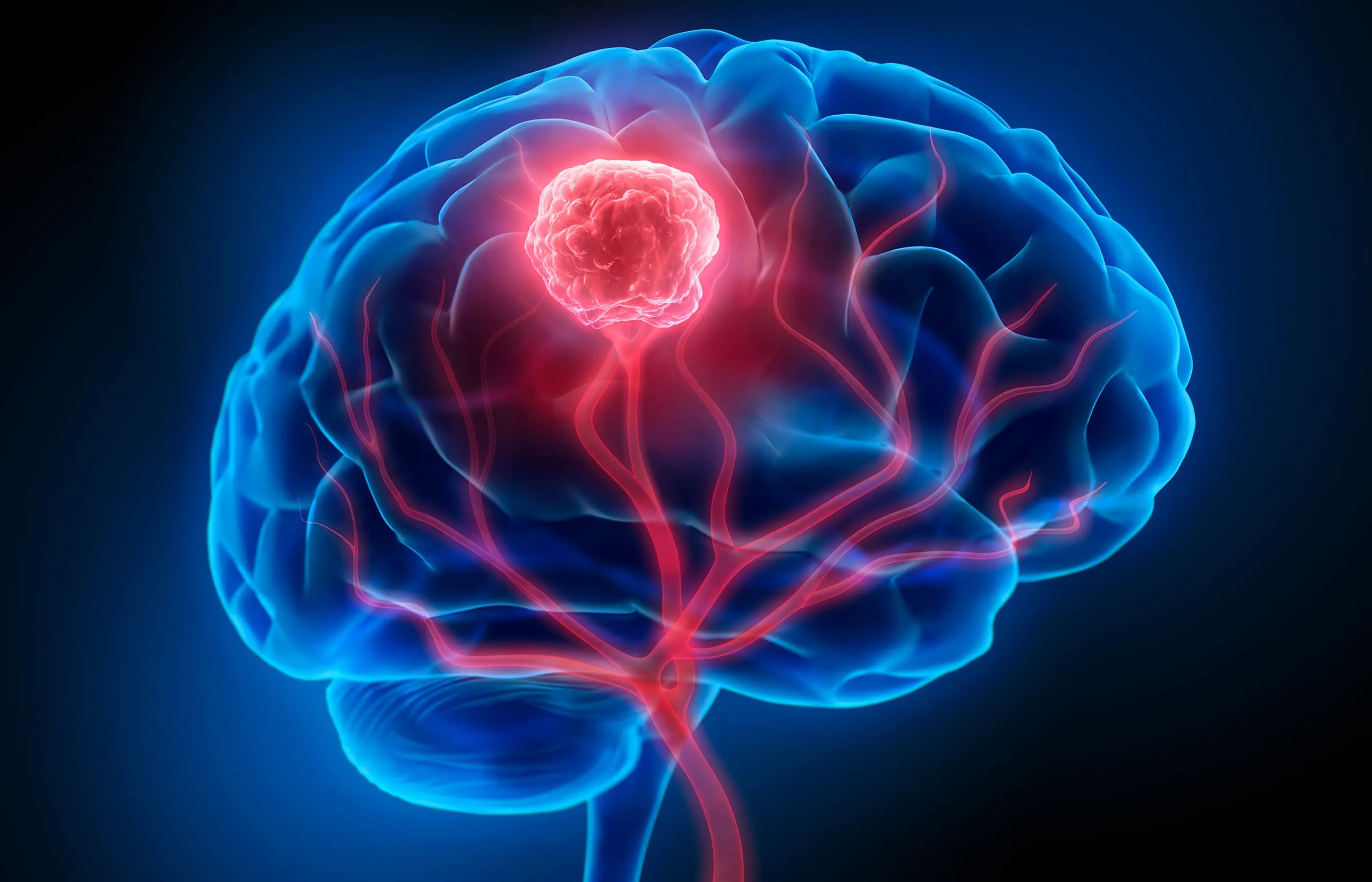 Brain tumor