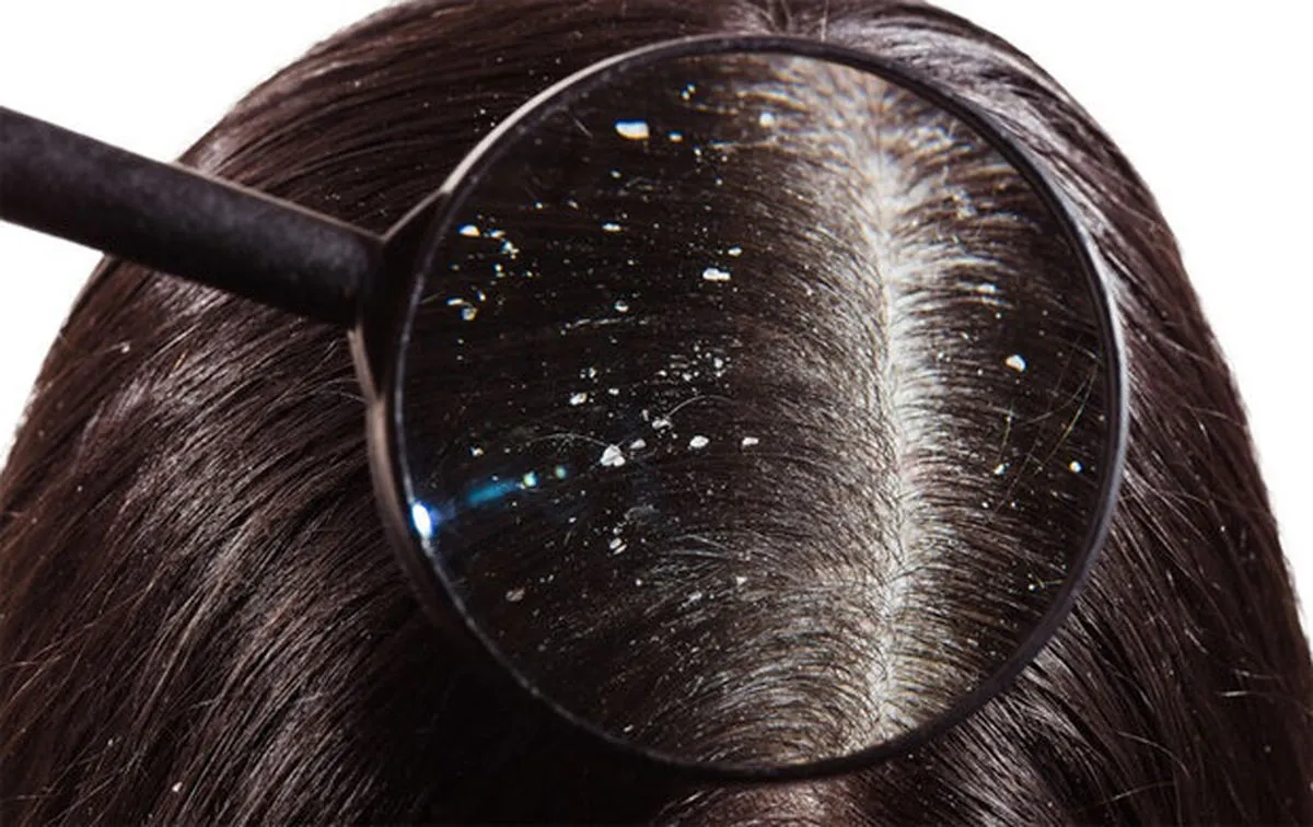Dandruff