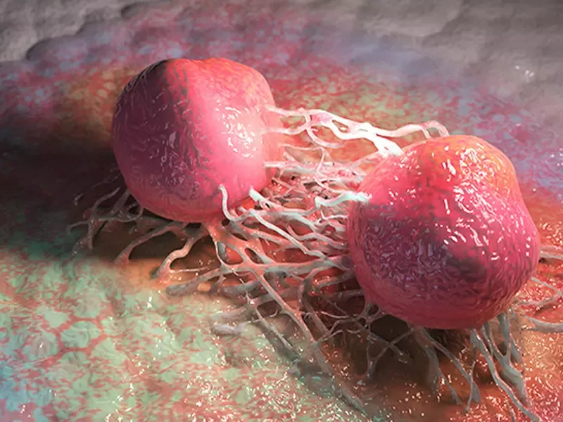 Prostate cancer 1