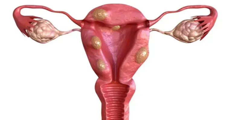 Uterine fibroids