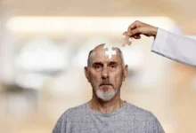 زوال عقل