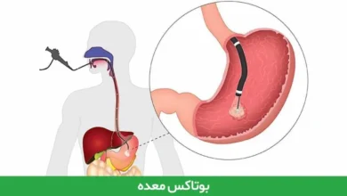 بوتاکس صورت با میخک