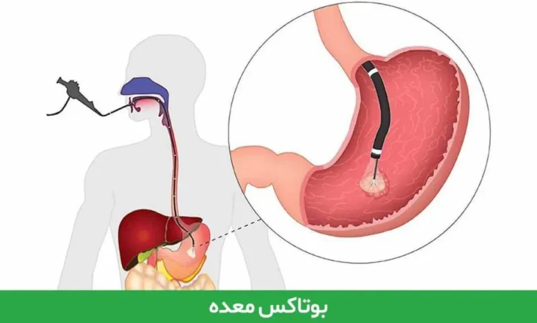 بوتاکس