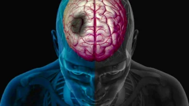 علائم سکته قلبی و مغزی