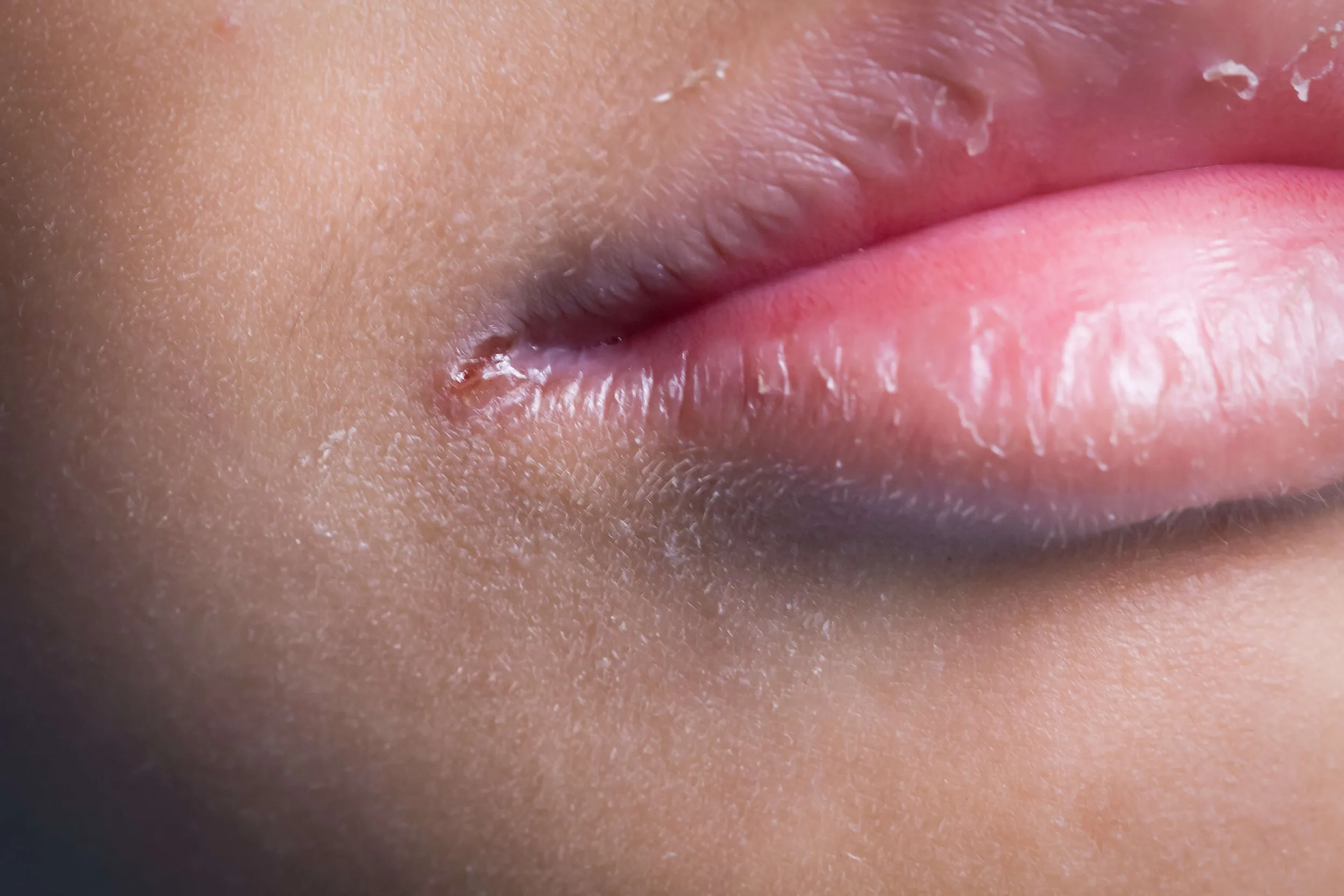 Cracks in the corners of the mouth