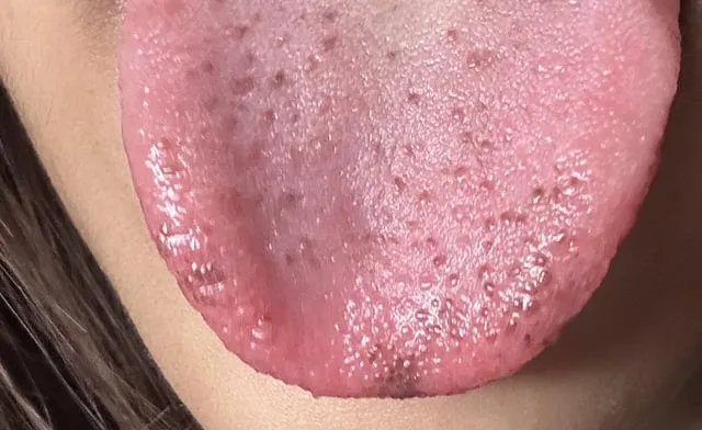 Dark Black Spots on the Tongue