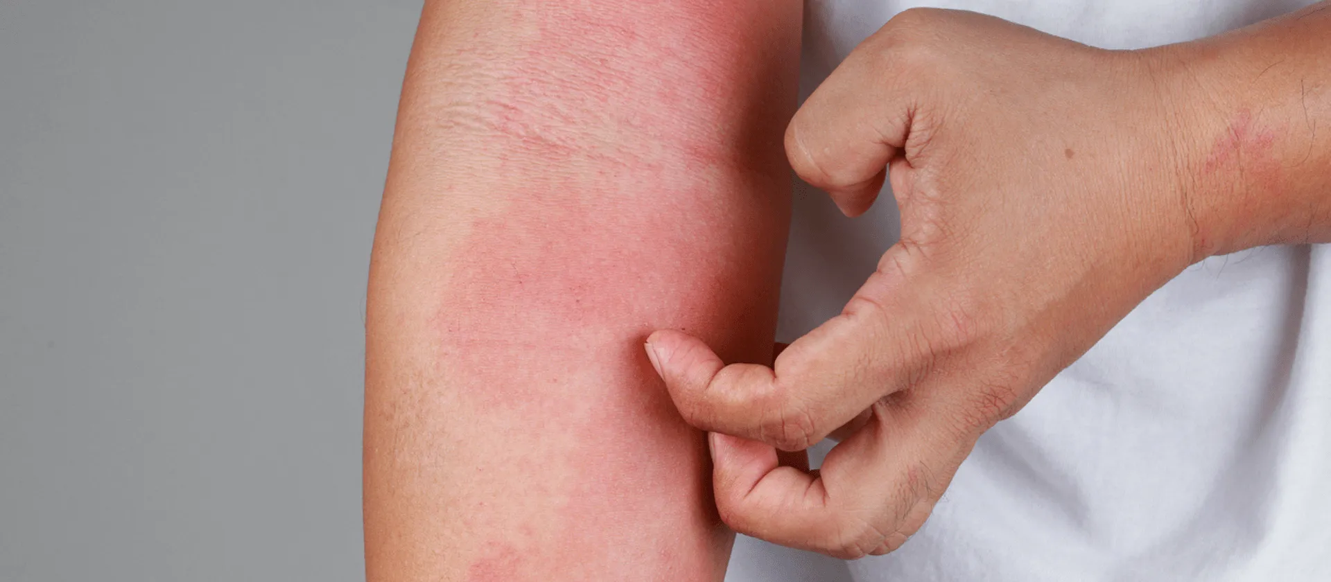Itchy eczema 1