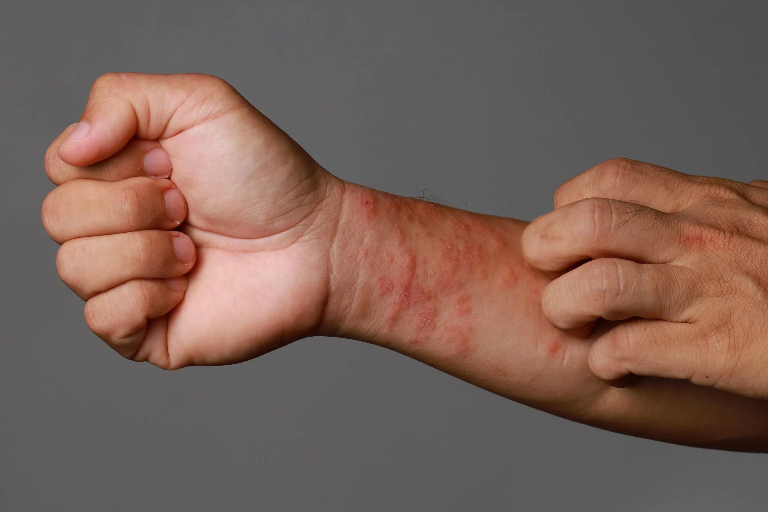 Itchy eczema 2 scaled