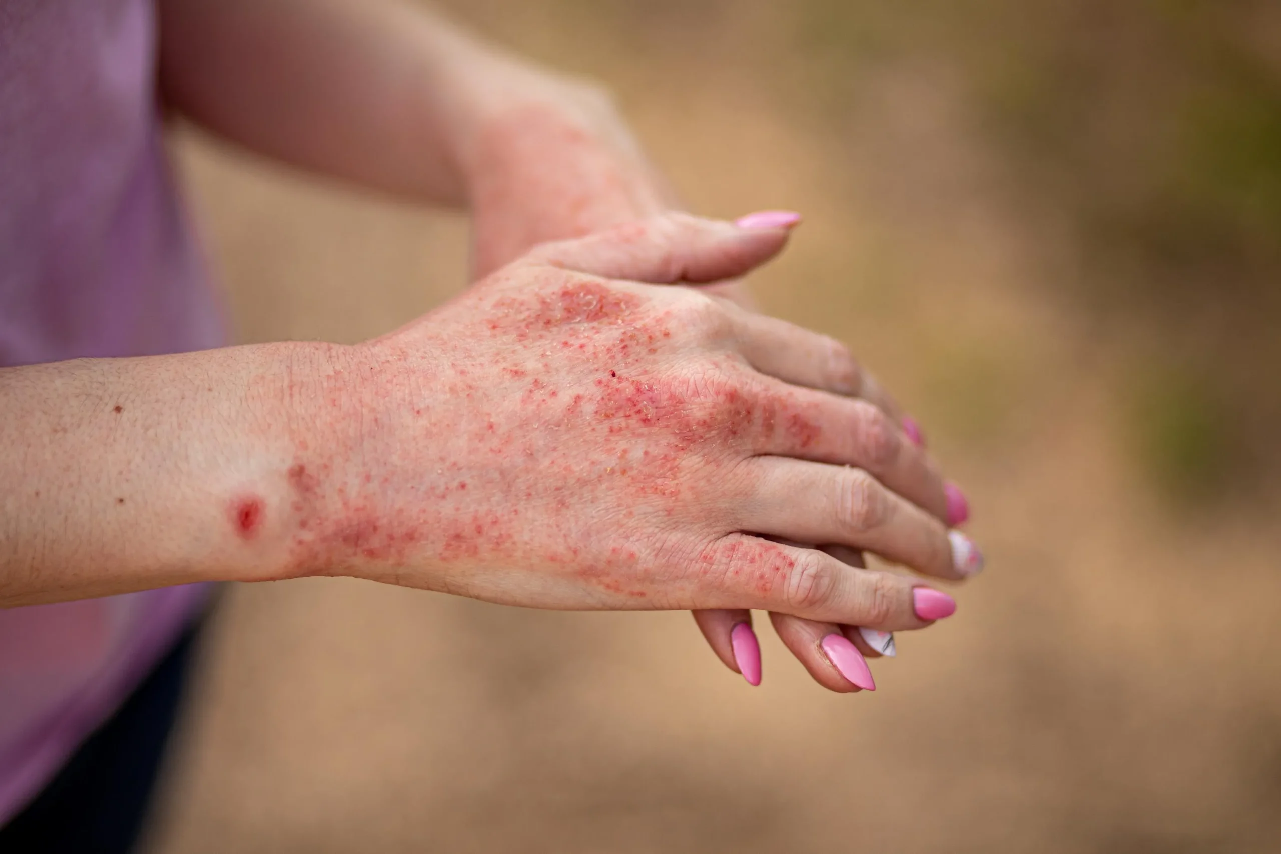 Itchy eczema 3 scaled
