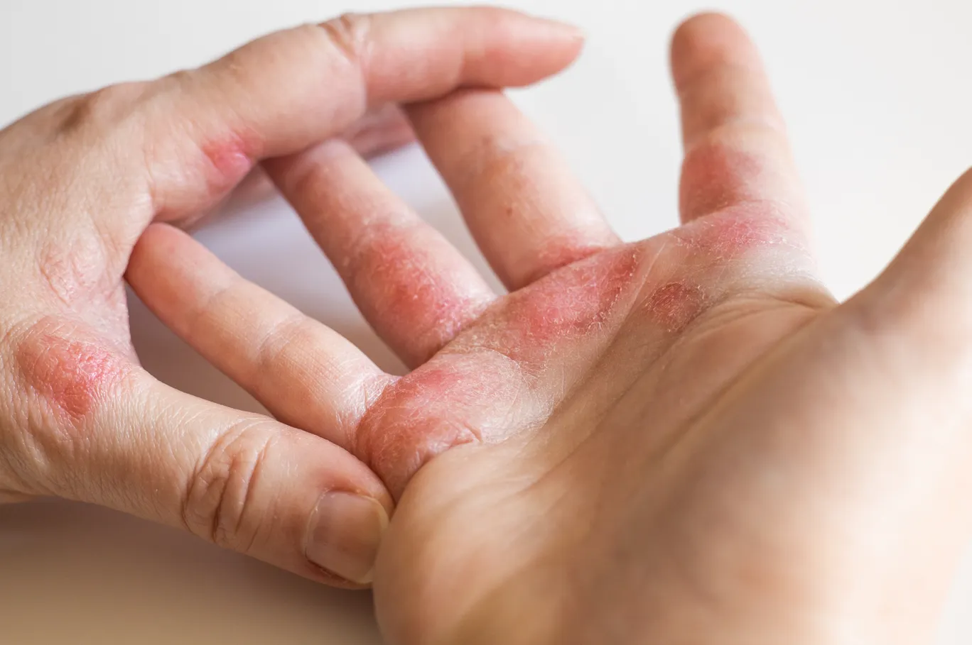 Itchy eczema