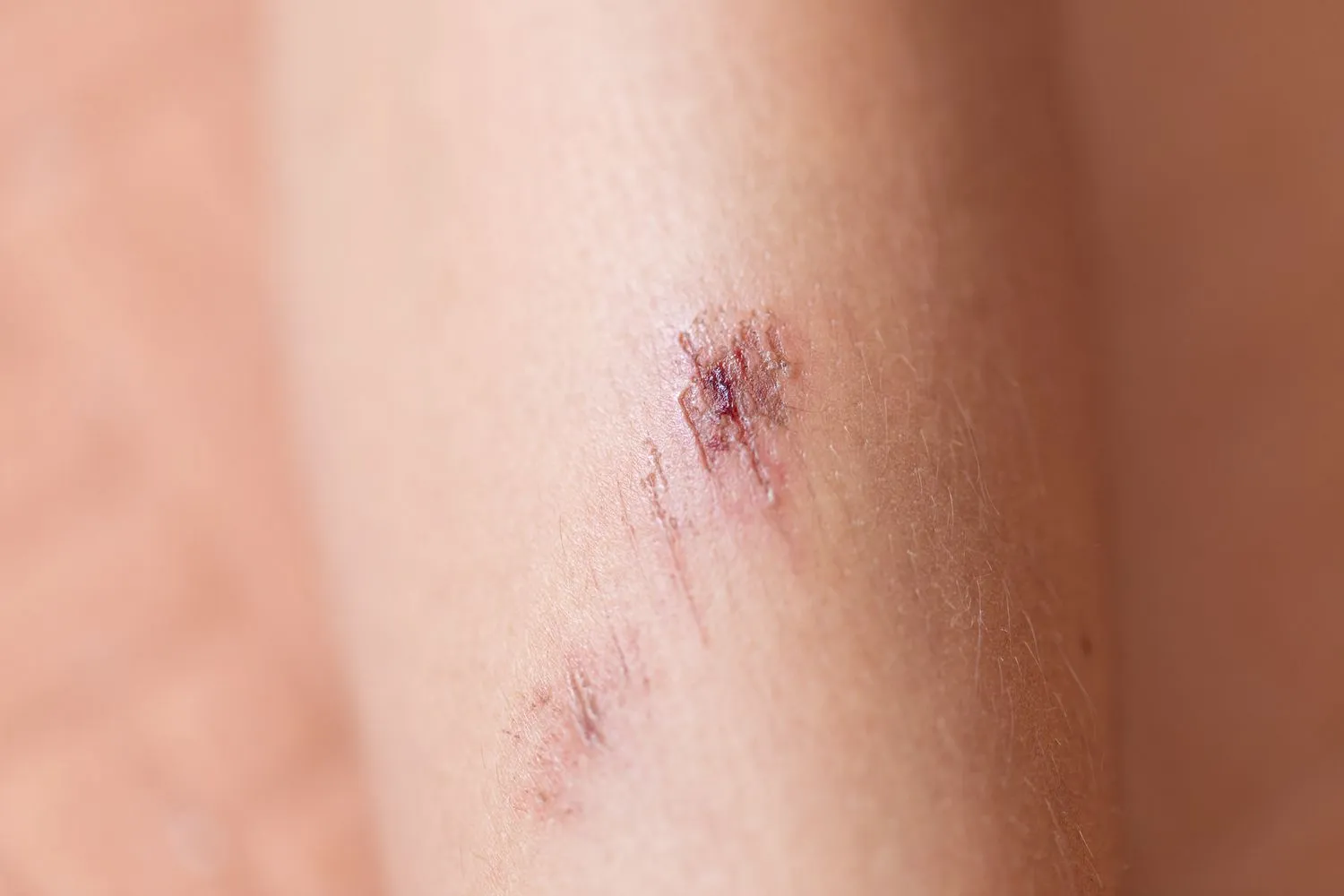 Skin wounds that take a long time to heal