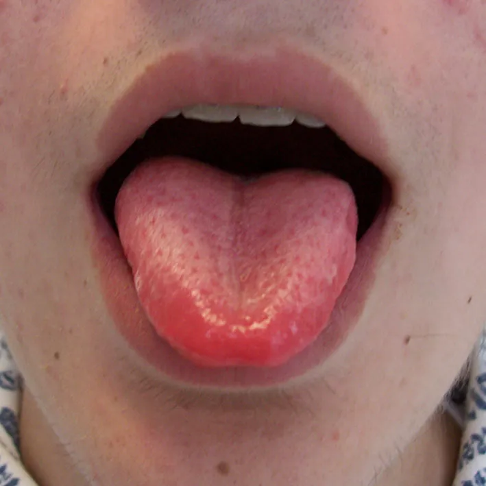 Sore and red tongue