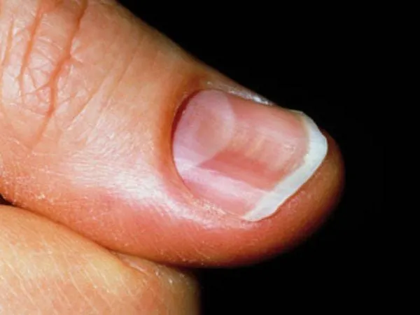 Spoon shaped nails