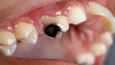 پوسیدگی دندان