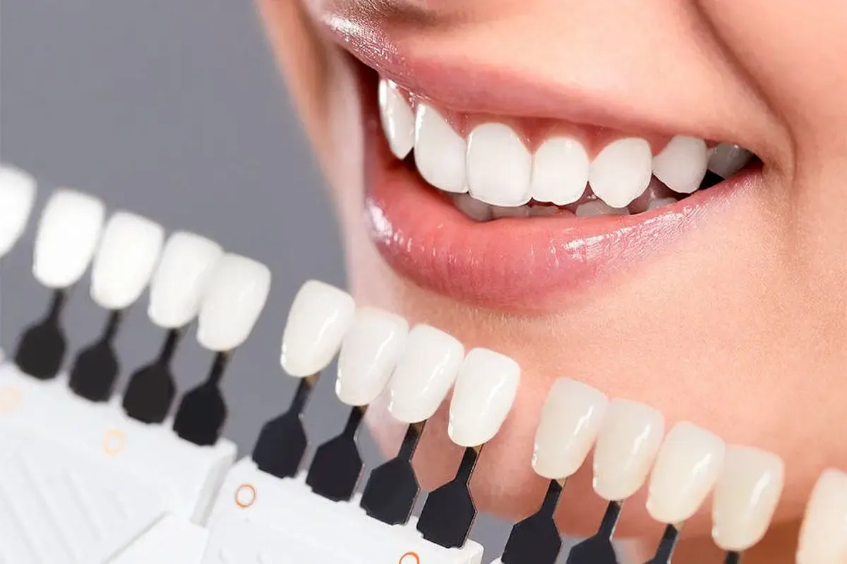 لمینت و کامپوزیت برای چه افرادی مناسب نیست؟