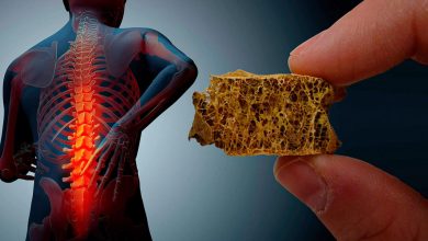 پوکی استخوان