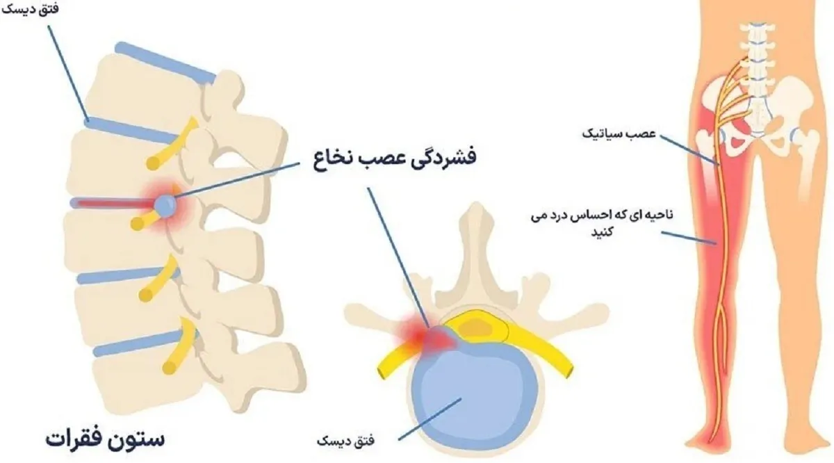 قولنج