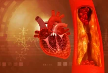 علائم سکته قلبی و مغزی