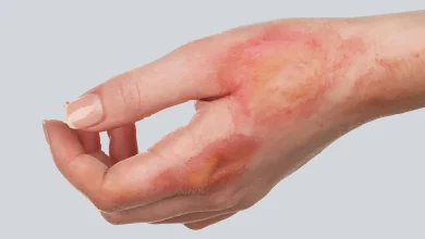 سوختگی با بخار