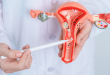 سندروم داون