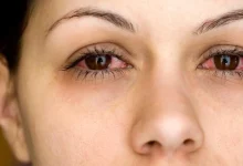 هشدار متخصص چشم درباره مشکلات رایج چشمی در فصل زمستان