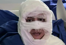 سوزاندن چهره یک زن