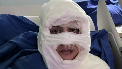 سوزاندن چهره یک زن