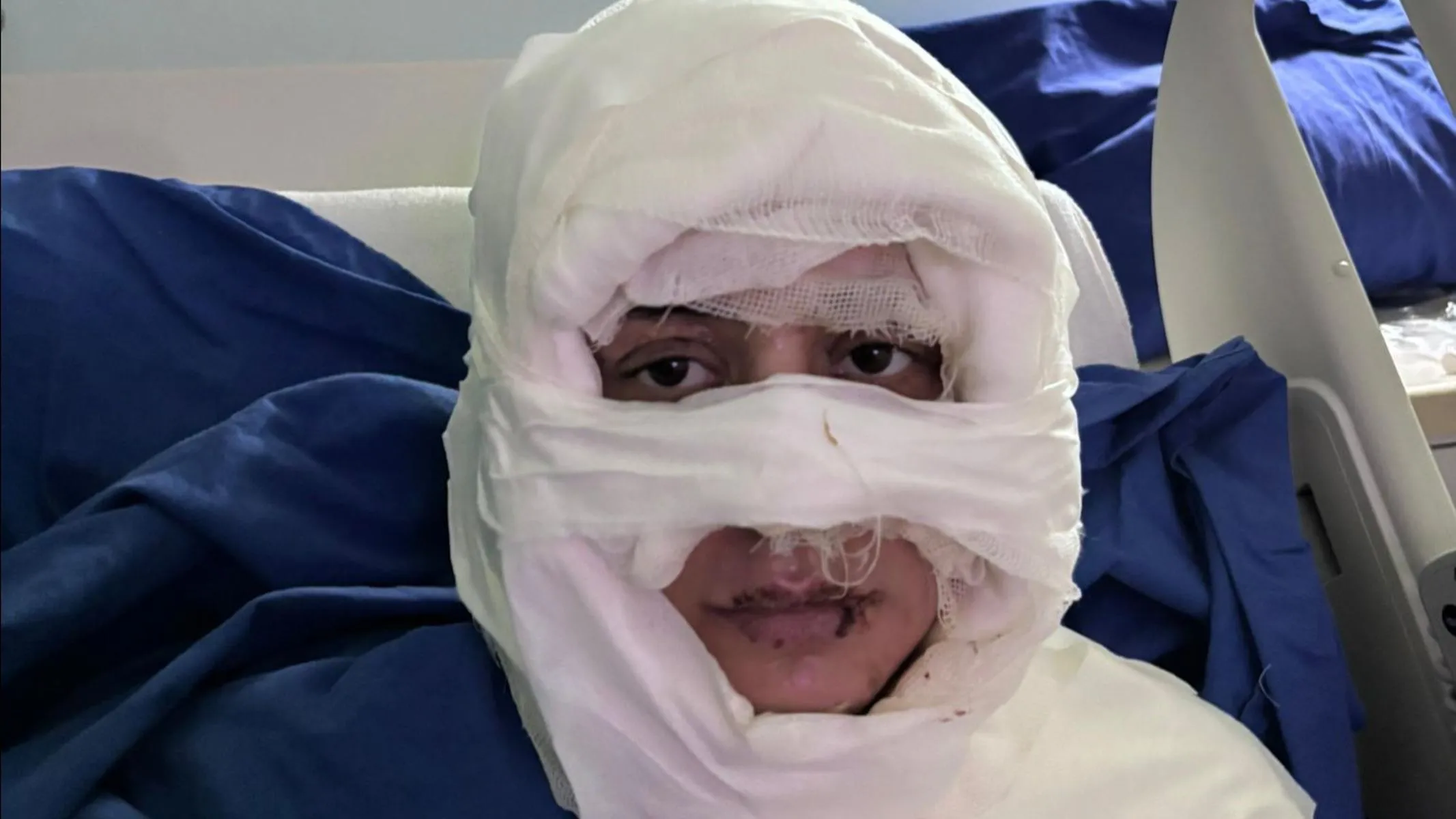 سوزاندن چهره یک زن