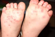 آیا تب برفکی به انسان منتقل می‌شود؟