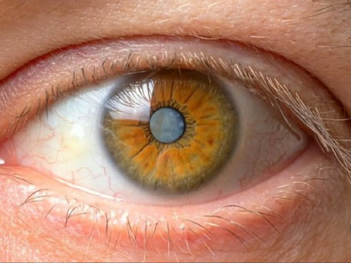 چگونه بفهمیم آب مروارید داریم؟