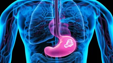 ۵ علامت مهم سرطان معده را بشناسید