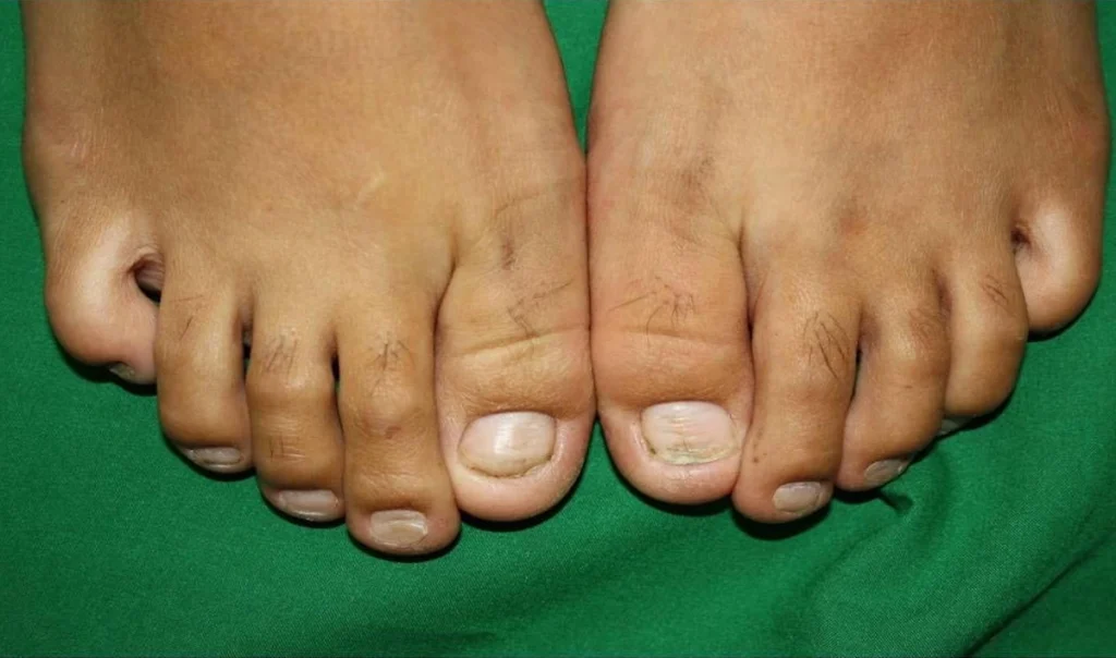 هر آنچه که ناخنهای پا در مورد سلامتی به ما میگویند 10 1 5