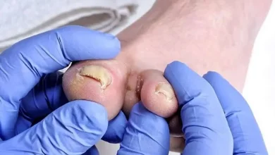 هر آنچه که ناخنهای پا در مورد سلامتی به ما میگویند 2 203