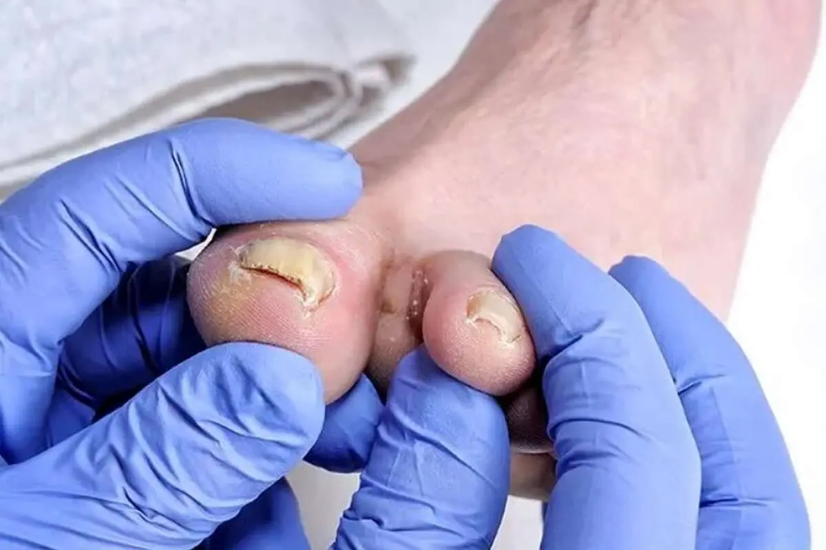 هر آنچه که ناخنهای پا در مورد سلامتی به ما میگویند 1 203