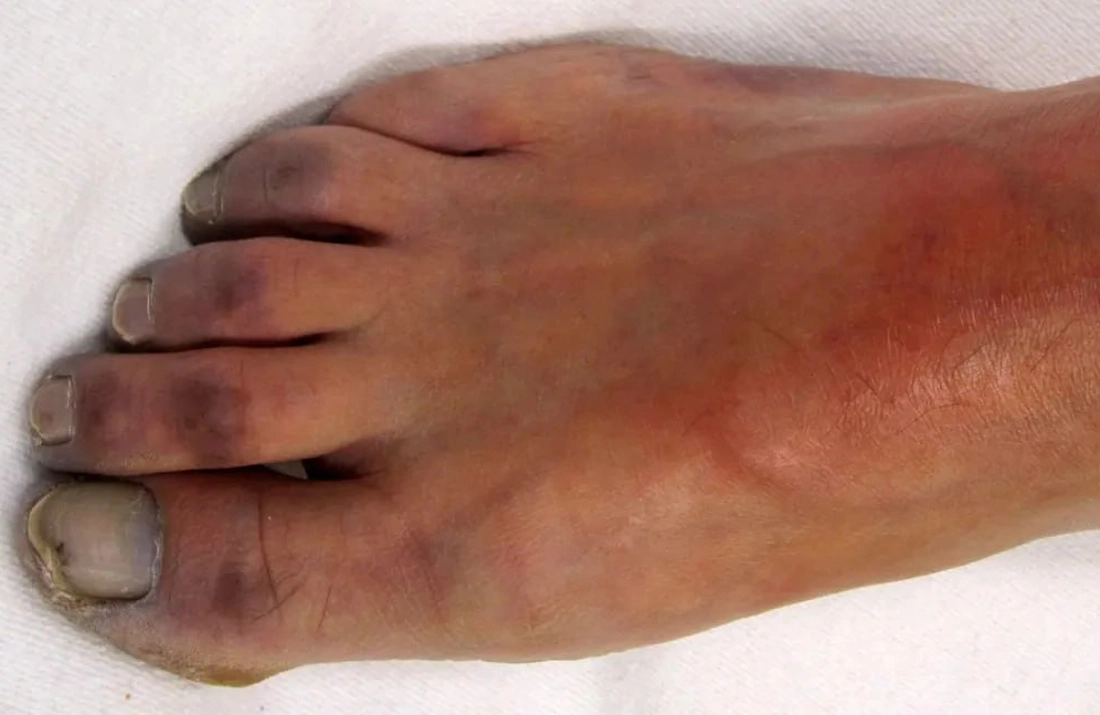 هر آنچه که ناخنهای پا در مورد سلامتی به ما میگویند 7 4 52